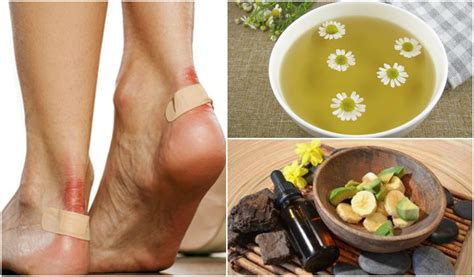 Alivia Las Rozaduras En Los Pies Con Estas Soluciones Naturales