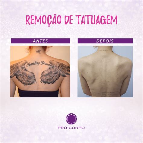 Remoção de Tatuagem Dicas e informações Pró Corpo