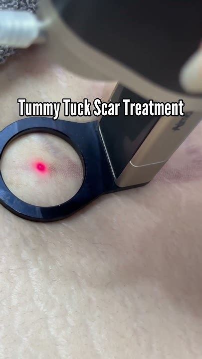 Tummy Tuck Scar Treatment Post Surgery Scars Acne Scar Treatment Alma Hybrid Lasers Youtube