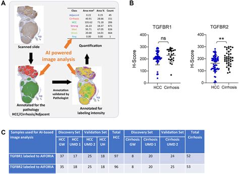 AI Based Analysis Of TGFBR1 And TGFBR2 Staining Intensity In HCC And