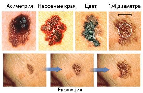 Опасные родинки, как отличить от безобидных, признаки | БебиКлад