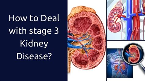 How to Deal with Stage 3 Kidney Disease