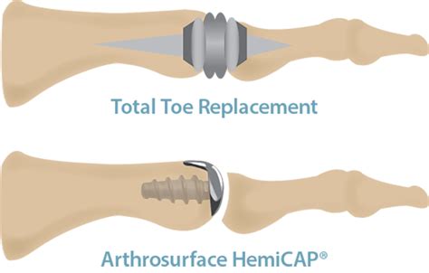 Hallux Rigidus Arthrodesis