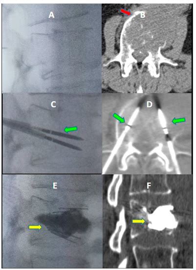 Jcm Free Full Text Percutaneous Vertebral Reconstruction Pvr