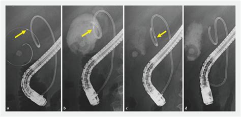 One Step Gallbladder Aspiration Irrigation In The Process Of Endoscopic