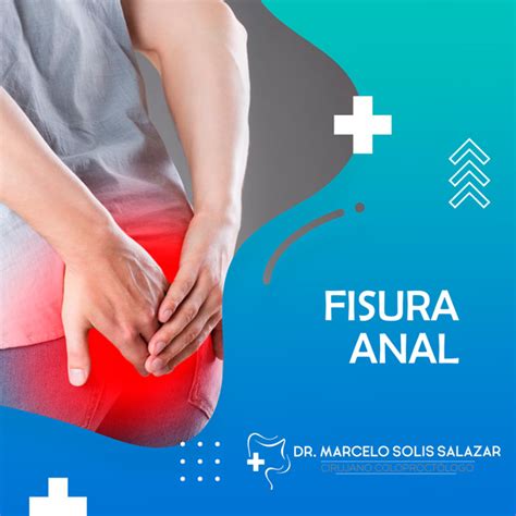 Dr Marcelo Solis Fisura Anal