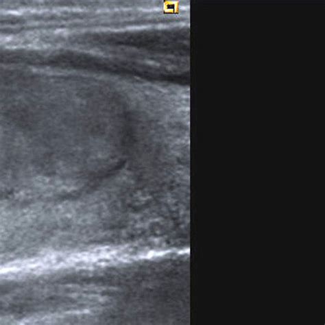 Nódulo Tiroideo Sólido De Ecoestructura Homogénea Download Scientific Diagram