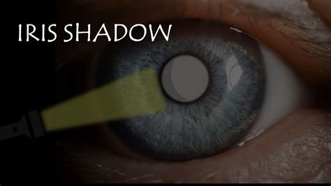 CONCEPT OF IRIS SHADOW Immature Vs Mature Cataract YouTube