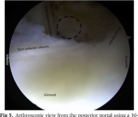 Figure 5 From Arthroscopic Labral Repair Using Knotless Suture Anchors In The Setting Of A 270