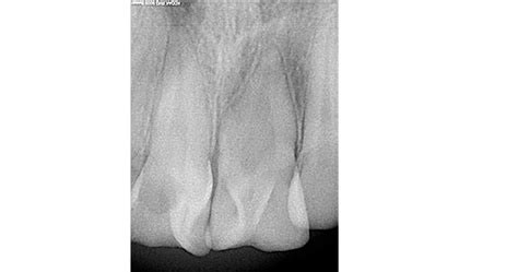 Radiographic Appearance Of Teeth The Talon Cusps Are Represented By