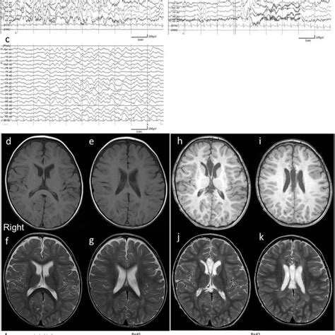 Epileptic Individuals With No Periventricular Nodular Heterotopia