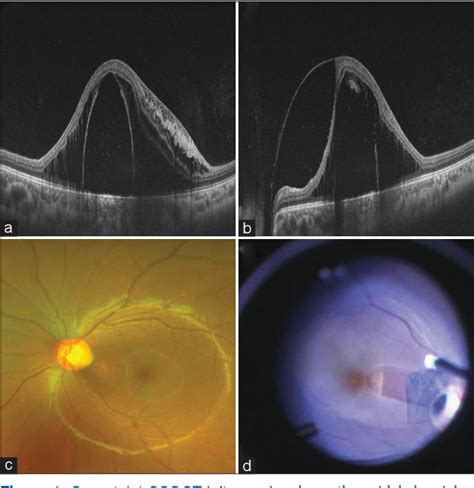 Figure 1 From Optic Disc Pit Maculopathy And Its Spectrum Of Management Semantic Scholar