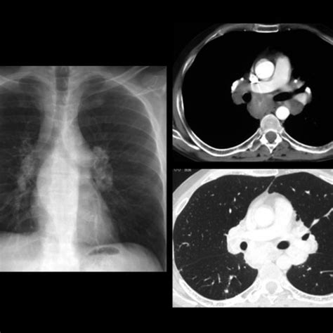 Hilar And Mediastinal Adenopathy In A 35 Year Old Woman Cect Clearly