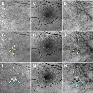 Multimodal Imaging Of The Left Eye Of A 68 Year Old Woman Obtained Over