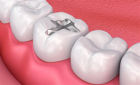 Types of Dental Fillings in Rocky Mountain House - ridesurfboard