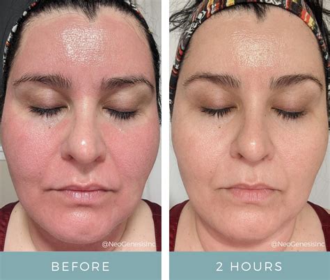 Before After Microneedling Neogenesis