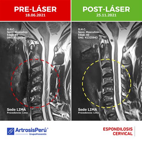 Espondilosis Cervical Artrosis Per