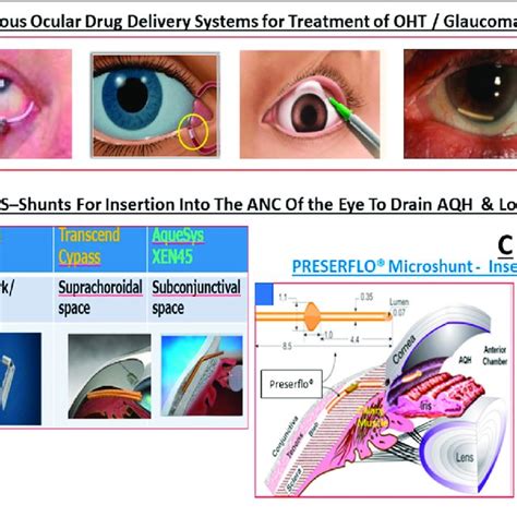 This Montage Depicts The Various Sustained Ocular Hypotensive Drug