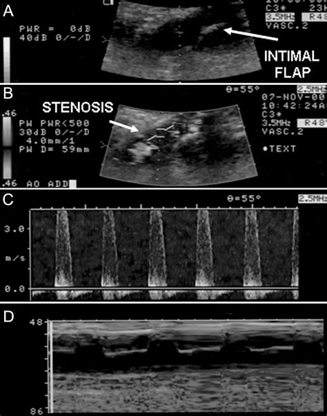 Figure From Intravascular Ultrasoundguided Stenting For Chronic