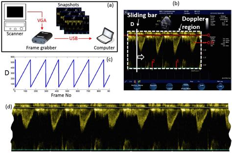 Figure From Automated Aortic Doppler Flow Tracing For Reproducible