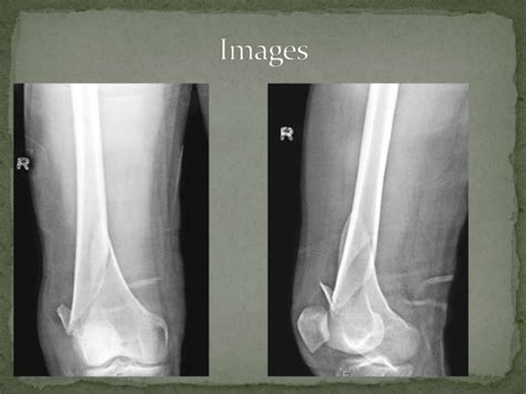 Supracondylar Femur Fracture