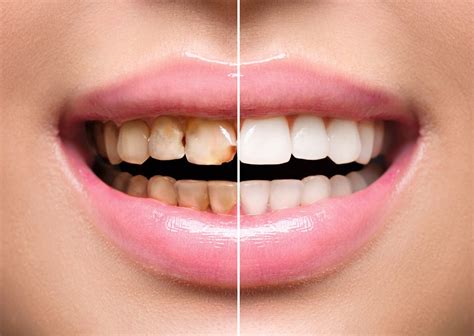 Composite veneer in Iran | Cosmetic dentistry | Composite veneer cost