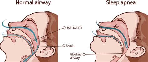 How Does Sleep Apnea Affect Your Health Dentist In Towson Md