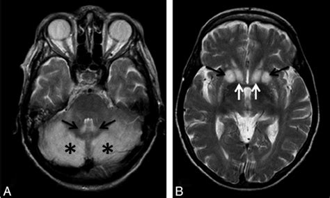 A The Cerebellar Hemispheres Asterisk S And Dentate Nuclei