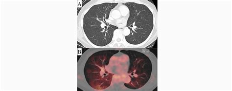 Intravascular Lymphoma Presenting With Hot Lung Sign Docquity