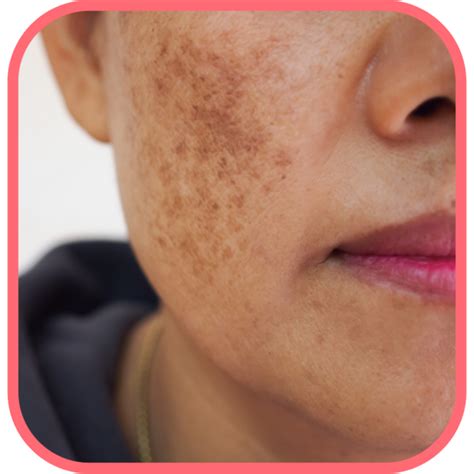 Melasma Vs Hyperpigmentation How To Spot The Difference