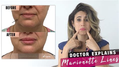 Mouth Wrinkles How To Treat Marionette Lines Doctor Explains Youtube