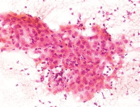 Significant Neutrophilic Infiltration Into The Tumor Cells And The Download Scientific Diagram