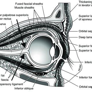 Arrow showing connective tissue bands between sclera and Tenon capsule ...