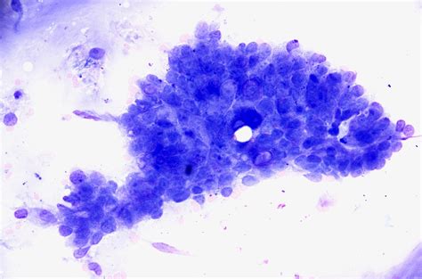 Ultrasound Guided Percutaneous Fine Needle Cytology Moderately