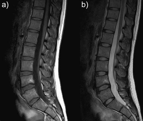 MRI at six months after onset (a) T1-weighted imaging (T1WI). (b ...