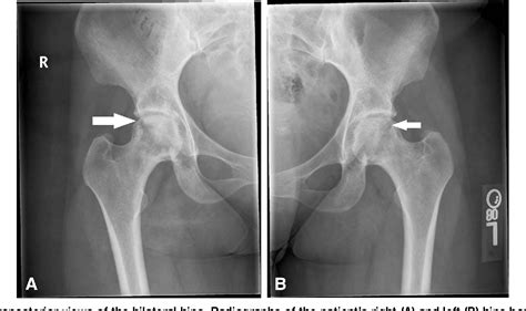 Avascular Necrosis Hip MRI