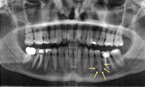 Periapical Cemental Dysplasia Stages