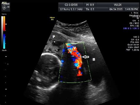 Invasive placenta praevia, Case 1. Ultrasound examination at Doppler ...