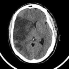 Cms Ii Neuro Neurologic Emergencies Flashcards Quizlet