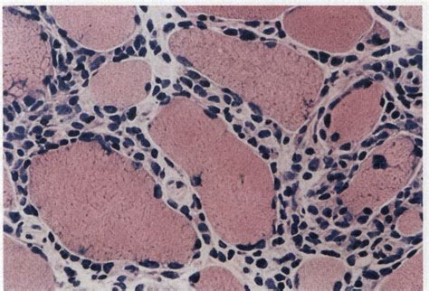 Severe Polymyositis