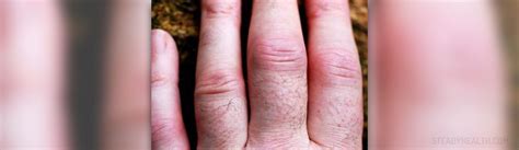 Inflammatory arthritis types, symptoms and treatment | General center | SteadyHealth.com