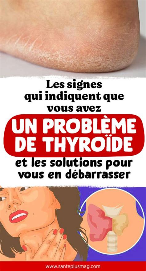 problème de thyroïde symptômes