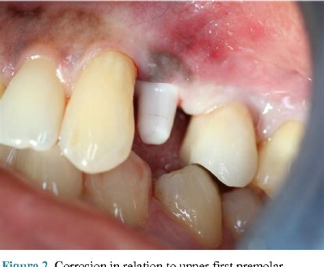 Figure From Corrosion Aspect Of Dental Implantsan Overview And