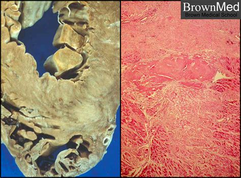 Amyloidosis