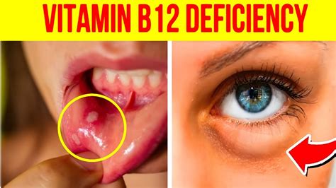 15 Visible Signs You Have Vitamin B12 Deficiency Youtube