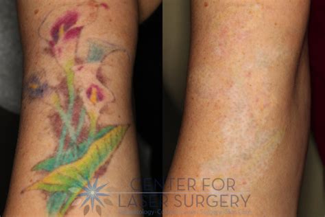 Expert Tattoo Removal Washington Dc Center For Laser Surgery