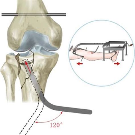 Demonstrative Case With Acl Footprint Avulsion A D Pre Operative