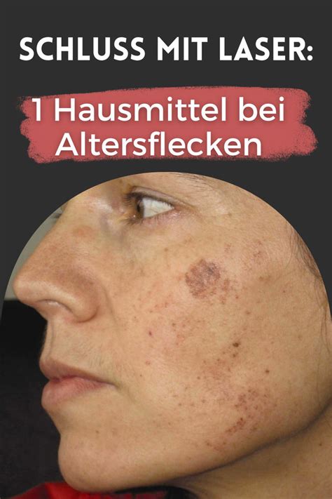 Hausmittel Bei Altersflecken 1 Mittel Hilft