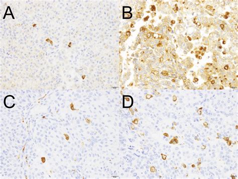 High Infiltration Of Cd163 Positive Macrophages In Intratumor Compartment Predicts Poor