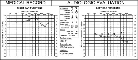 Audiogram Showing Normal Hearing Sensitivity In The Right Ear With Download Scientific Diagram